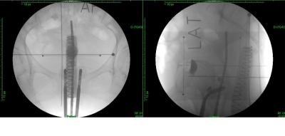 Brakhiterapi Pengambilan Gambar